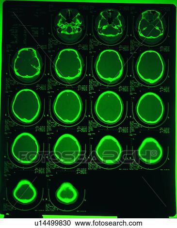 Stock Image - Green, Toned Image, Mri Scan, Human Brain, Part Of, Medical. Fotosearch