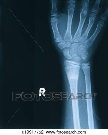 Indoor, X-Ray Image, Human Bone, Technology, Close-Up, Healthcare And Medicine View Large Photo Image Stock Image - Indoor, X-Ray Image, Human Bone, Technology, Close-Up, Healthcare And Medicine. Fotosearch