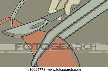 クローズアップ の A 外科医 手 切断 人間の静脈 で A ﾒｽ イラスト U Fotosearch