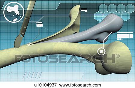 Close-up of a covering of a human bone being cut with a scalpel View Large Illustration Stock Illustration - Close-up of a covering of a human bone being cut with a scalpel. Fotosearch
