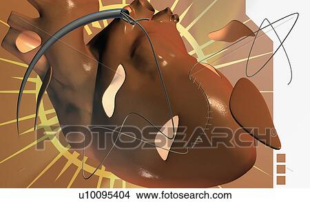 Close-up of stitches on a human heart View Large Illustration Stock Illustration - Close-up of stitches on a human heart. Fotosearch