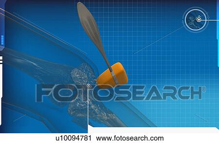 Reflex hammer on a human leg View Large Illustration Clip Art - Reflex hammer on a human leg. Fotosearch