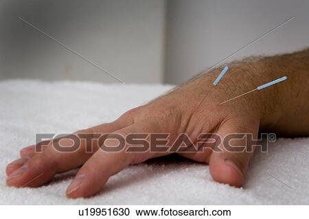 Man receiving acupuncture View Large Photo Image Stock Image - Man receiving acupuncture. Fotosearch