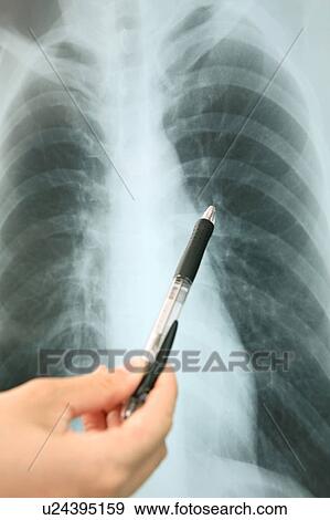 Stock Photo - X-ray. Fotosearch
