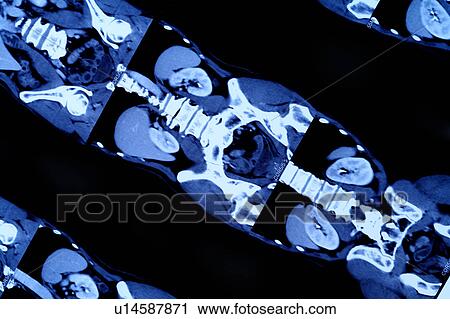 Stock Image - "CAT scan of abdomen, close-up". Fotosearch
