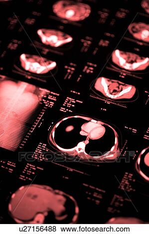 Stock Photo - "CAT scan of abdomen, close-up". Fotosearch