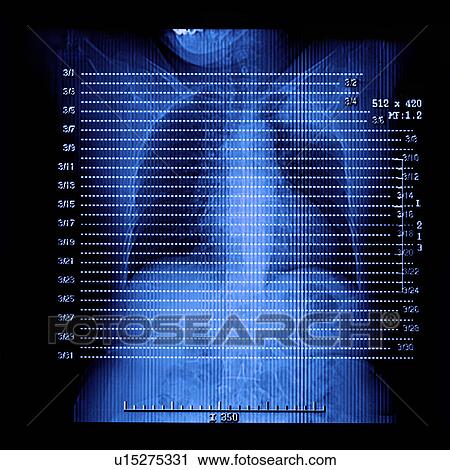 "CAT scan of chest, close-up" View Large Photo Image Stock Image - "CAT scan of chest, close-up". Fotosearch