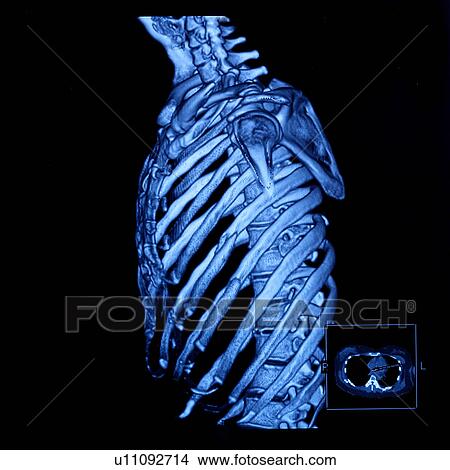 "CAT scan of human chest, close-up" View Large Photo Image Picture - "CAT scan of human chest, close-up". Fotosearch