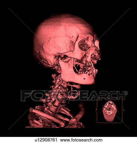Stock Image - "CAT scan of human head, close-up". Fotosearch