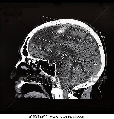 "CAT scan of human head, close-up" View Large Photo Image Stock Image - "CAT scan of human head, close-up". Fotosearch