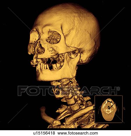 Stock Photo - "CAT scan of human head, close-up". Fotosearch