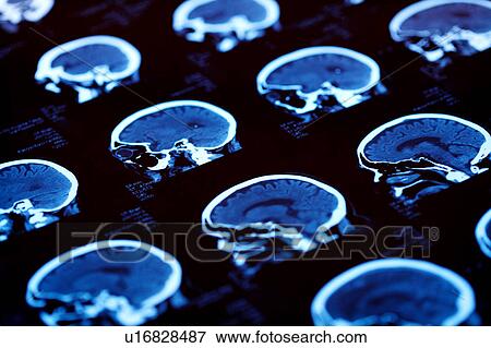 Stock Photo - "CAT scan of human head, close-up". Fotosearch