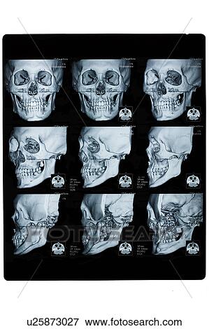 Stock Photo - "CAT scan of human head, close-up". Fotosearch