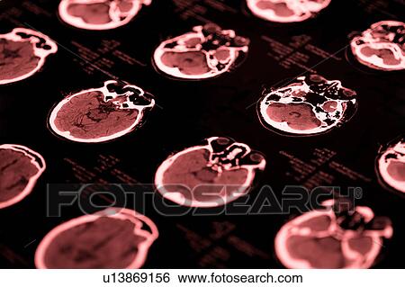"CAT scan of human head, close-up" View Large Photo Image Stock Photograph - "CAT scan of human head, close-up". Fotosearch