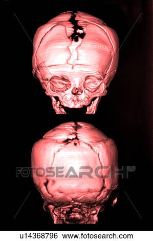 "CAT scan of human head, close-up" View Large Photo Image Stock Photograph - "CAT scan of human head, close-up". Fotosearch