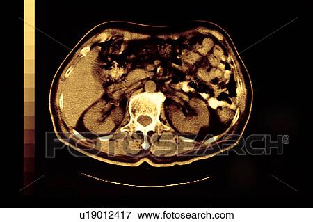 Stock Photo - "CAT scan of waist, close-up". Fotosearch