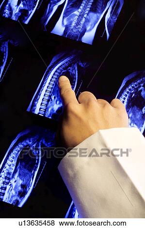 "Man's hand pointing at MRI scan of human spine, close-up" View Large Photo Image Stock Photo - "Man's hand pointing at MRI scan of human spine, close-up". Fotosearch