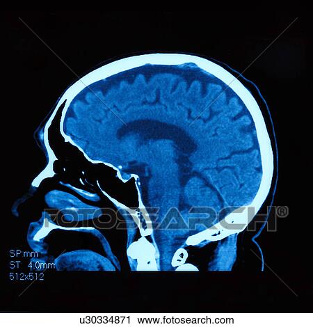 Stock Image - "Medical scan of human head, close-up". Fotosearch