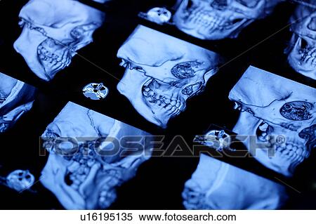 Stock Photography - "Medical scan of human head, close-up". Fotosearch