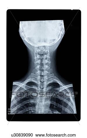 Stock Image - "Medical scan of human spine, close-up". Fotosearch