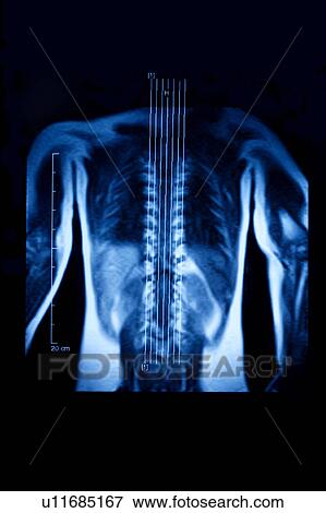 Stock Photo - "Medical scan of human spine, close-up". Fotosearch