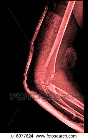 "Medical scan of screw on human bone, close-up" View Large Photo Image Picture - "Medical scan of screw on human bone, close-up". Fotosearch