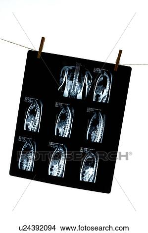 MRI scan of human bone hanging on a rope View Large Photo Image Picture - MRI scan of human bone hanging on a rope. Fotosearch