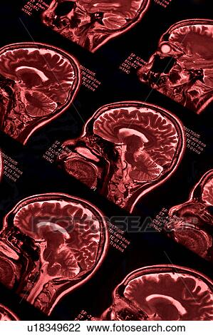 Stock Image - "MRI scan of human brain, close-up". Fotosearch