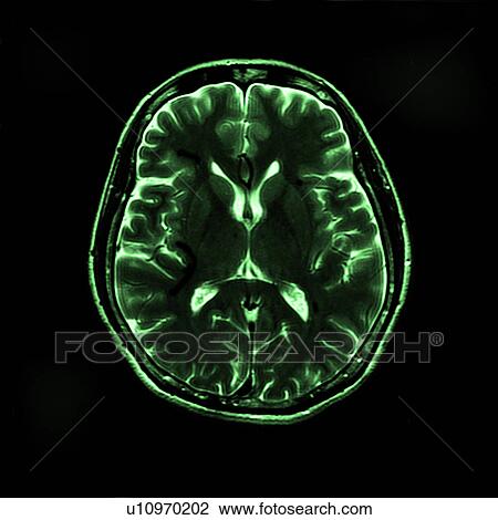 Stock Image - "MRI scan of human head, close-up". Fotosearch