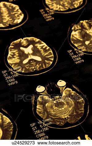 "MRI scan of human head, close-up" View Large Photo Image Stock Image - "MRI scan of human head, close-up". Fotosearch