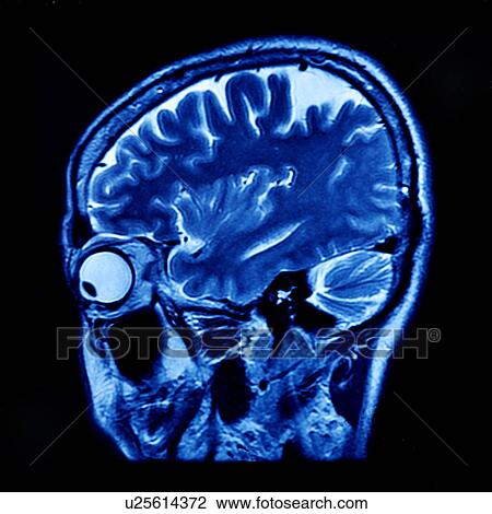 Stock Image - "MRI scan of human head, close-up". Fotosearch