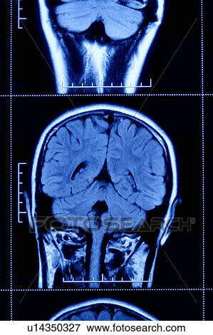 Stock Photo - "MRI scan of human head, close-up". Fotosearch
