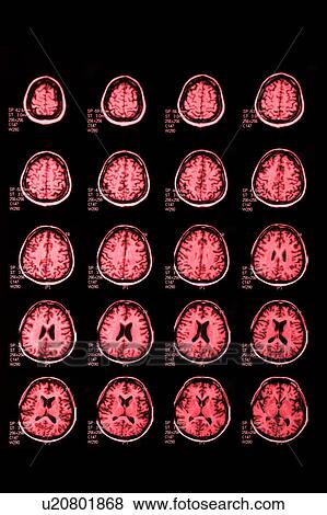 Stock Photo - "MRI scan of human head, close-up". Fotosearch