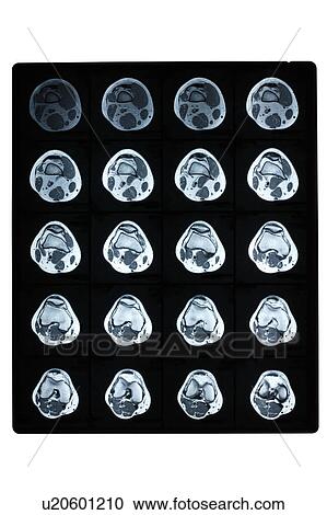 Stock Image - "MRI scan of human knee, close-up". Fotosearch
