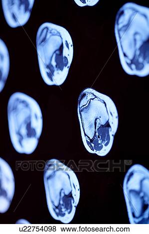 Stock Photo - "MRI scan of human knee, close-up". Fotosearch