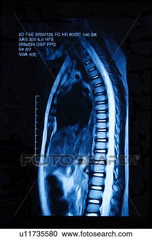 "MRI scan of human spine, close-up" View Large Photo Image Stock Image - "MRI scan of human spine, close-up". Fotosearch