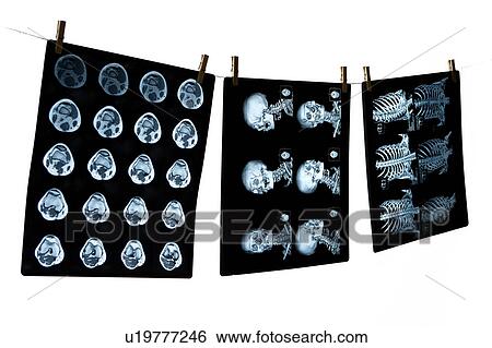 Three medical scan hanging on the rope View Large Photo Image Stock Photograph - Three medical scan hanging on the rope. Fotosearch