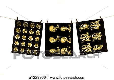 Picture - Three X-Ray images hanging on a rope. Fotosearch