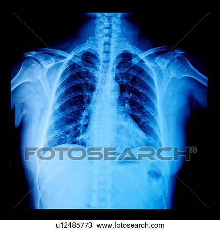 Stock Image - "X-ray image of chest, close-up". Fotosearch