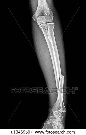 "X-ray image of fracture of human leg, close-up" View Large Photo Image Stock Photo - "X-ray image of fracture of human leg, close-up". Fotosearch