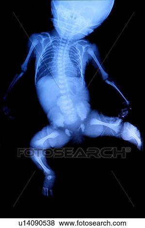 Stock Photo - "X-ray image of human bone, close-up". Fotosearch