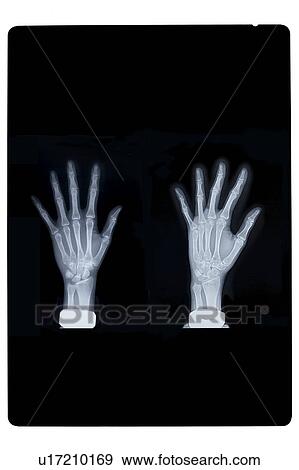 Stock Photo - "X-ray image of human hands, close-up". Fotosearch