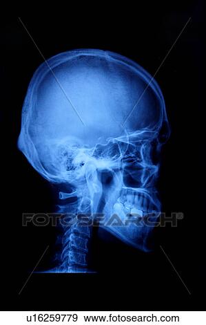 "X-ray image of human head, close-up" View Large Photo Image Stock Photo - "X-ray image of human head, close-up". Fotosearch
