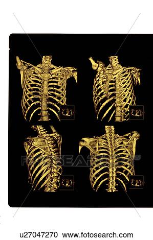 Stock Image - "X-ray image of human spine, close-up". Fotosearch