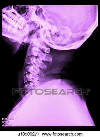Stock Photo - "X-ray of human neck, close-up". Fotosearch