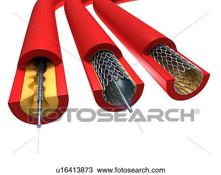 Drawing - Angioplasty, artwork. Fotosearch