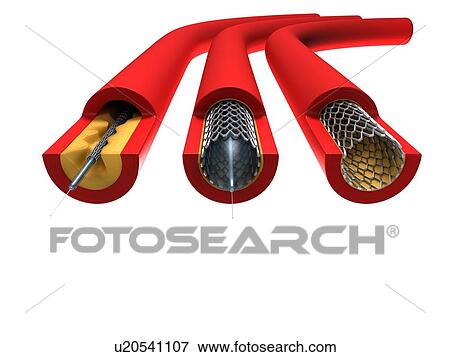 Angioplasty, artwork View Large Illustration Stock Illustration - Angioplasty, artwork. Fotosearch