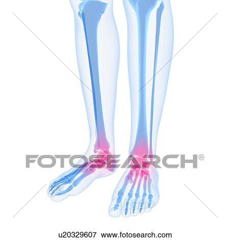 Ankle pain, conceptual artwork View Large Illustration Stock Illustration - Ankle pain, conceptual artwork. Fotosearch