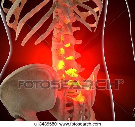 Back pain, conceptual artwork View Large Illustration Clipart - Back pain, conceptual artwork. Fotosearch
