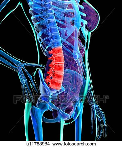 Stock Illustration - Back pain, conceptual artwork. Fotosearch